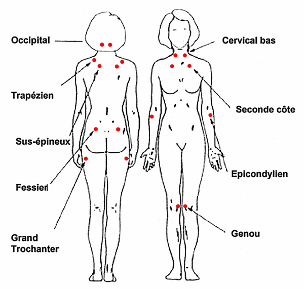 les 18 points de fibromyalgie